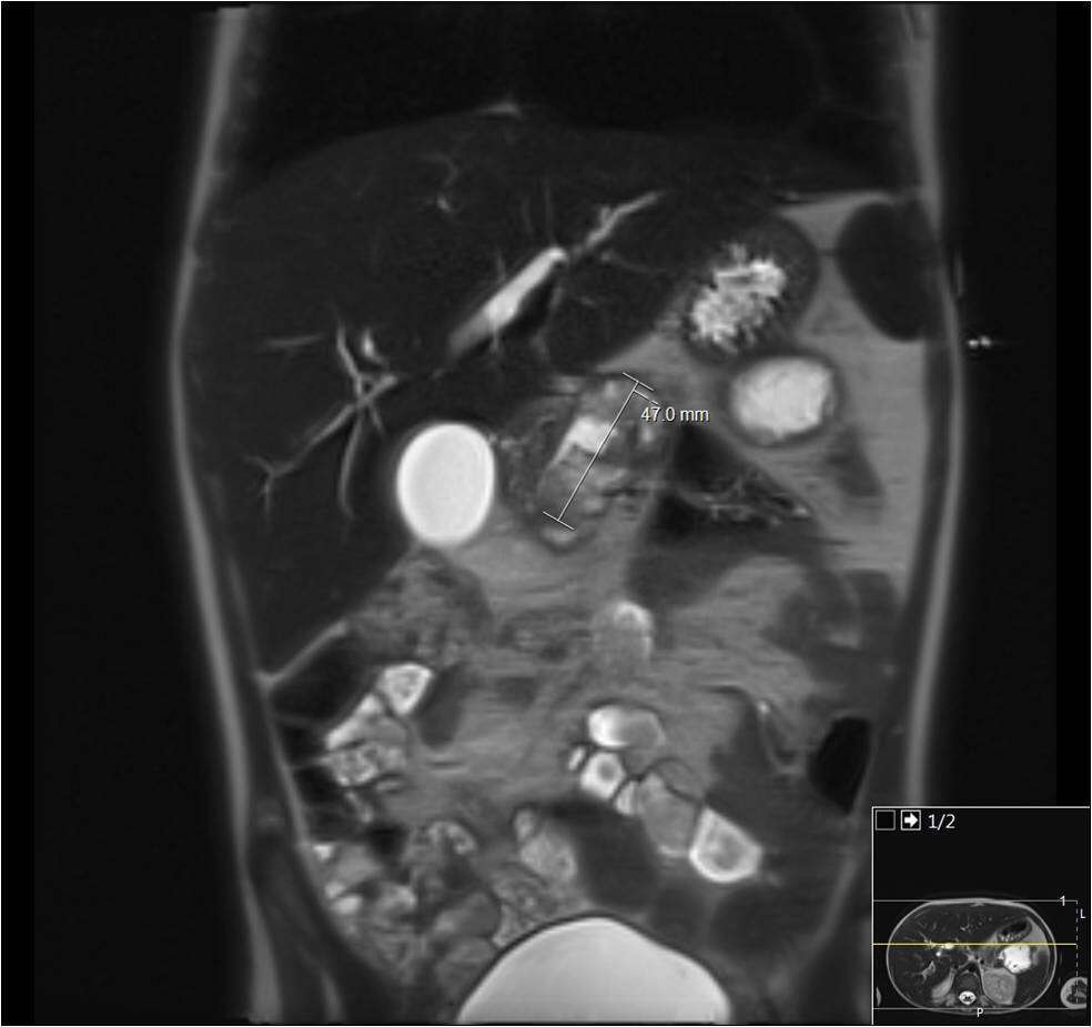 MRCP- pancreatic pseudocyst